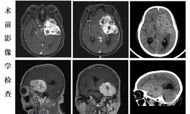 七旬老人突发偏瘫，医生精准摘除拳头大小脑瘤
