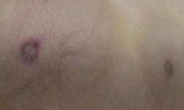 1死1伤，广西夫妻遭马蜂袭击，幸存者换掉80%问题血液惊险获救